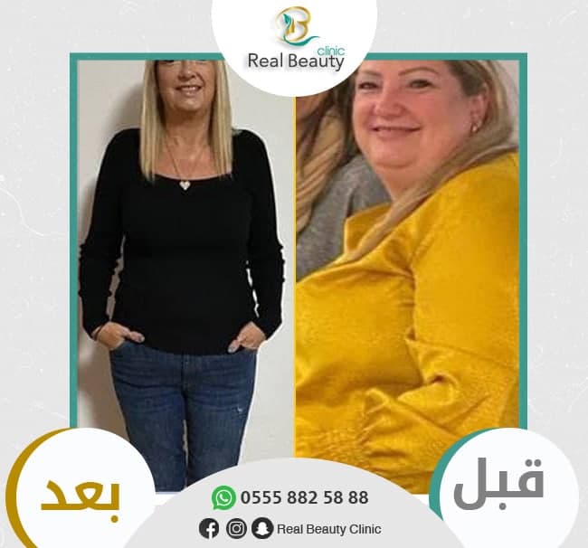 تحويل مسار المعدة في تركيا