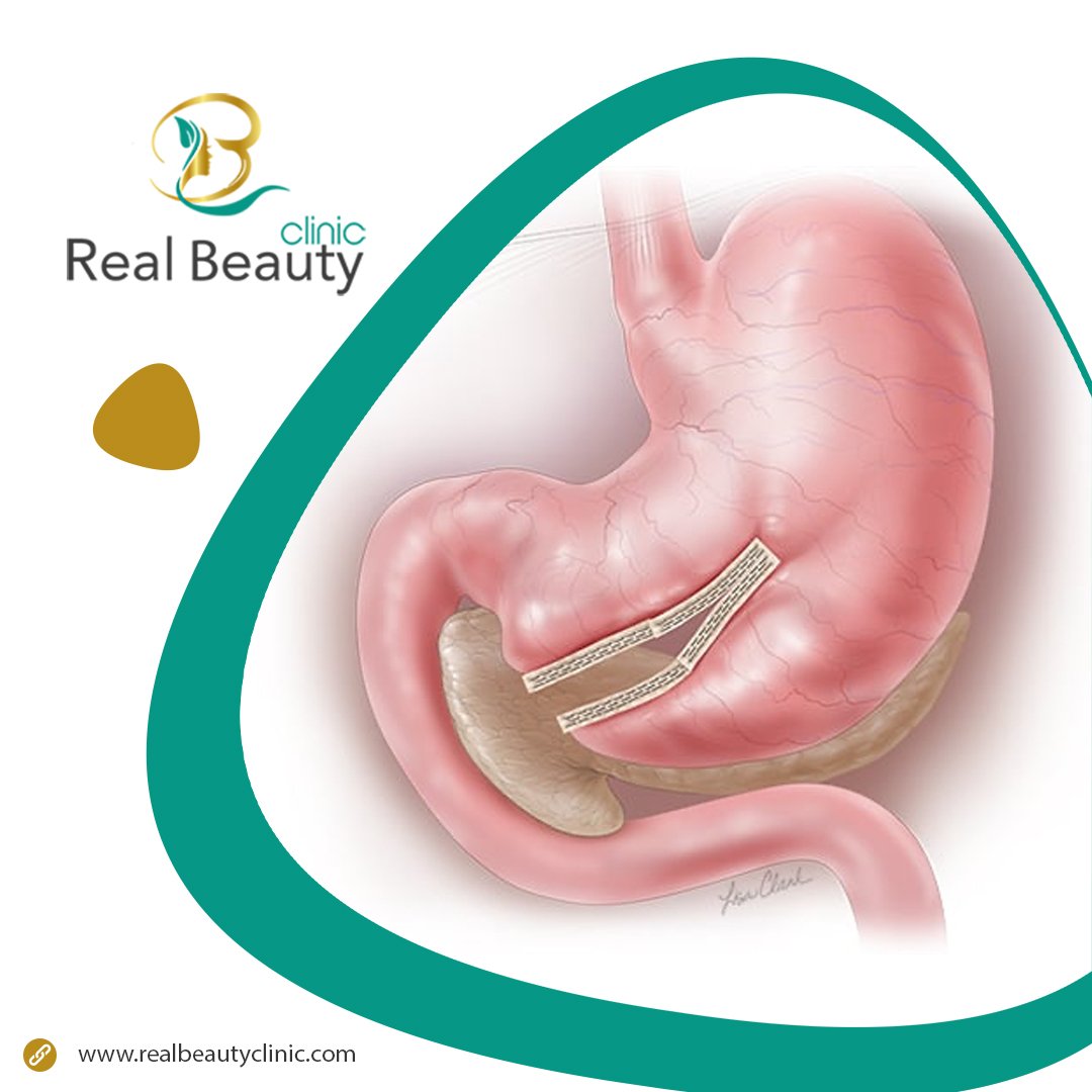Stomach stapling procedure - Real Beauty Clinic