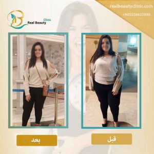 Gastric bypass conditions