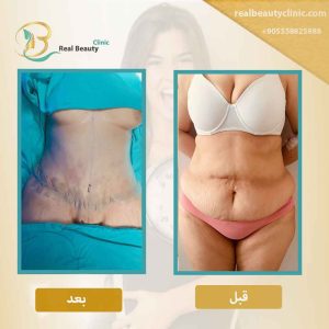 عملية شفط الدهون في تركيا 