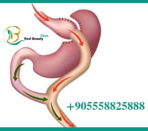 What is the difference between sleeve gastrectomy and gastric bypass?  