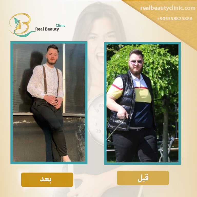 جراحة السمنة في تركيا