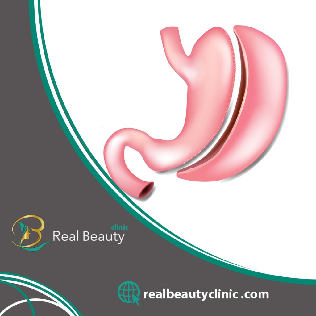 Gastric bypass surgery
