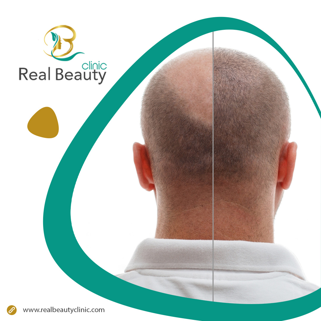 5 Modern hair transplant methods Real Beauty Clinic
