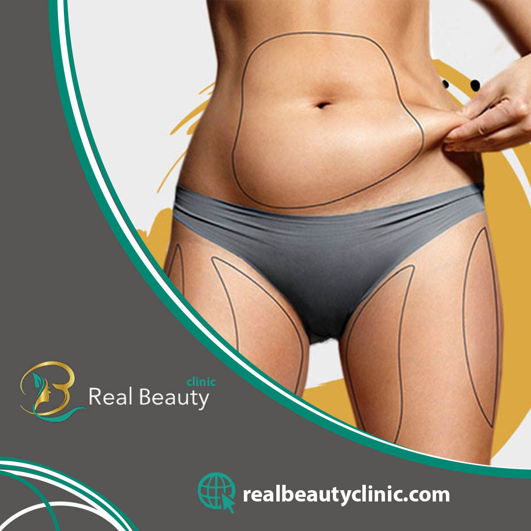 Liposuction in Turkey Real Beauty Clinic